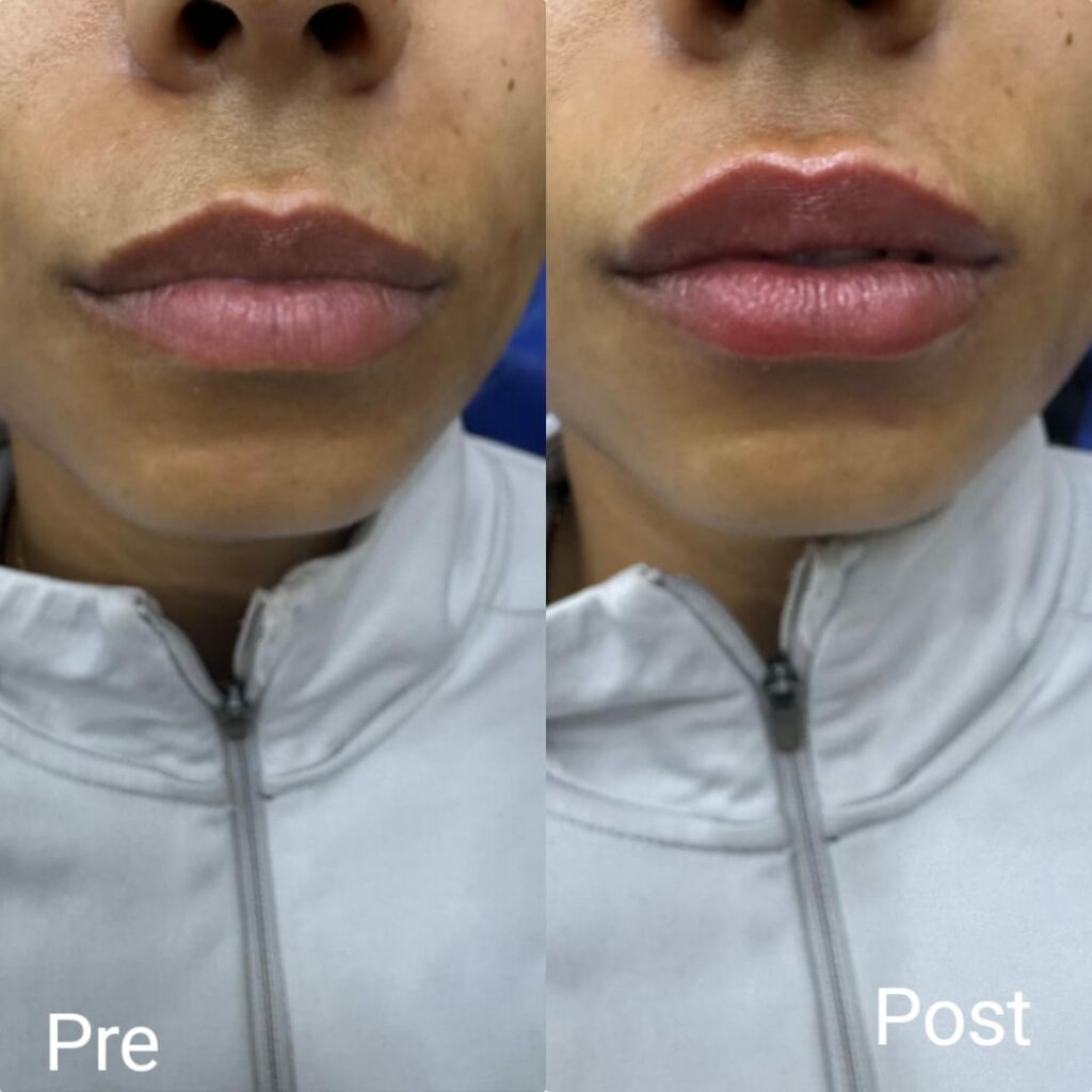 Lip contour with filler
